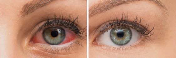 خشکی چشم چیست؟