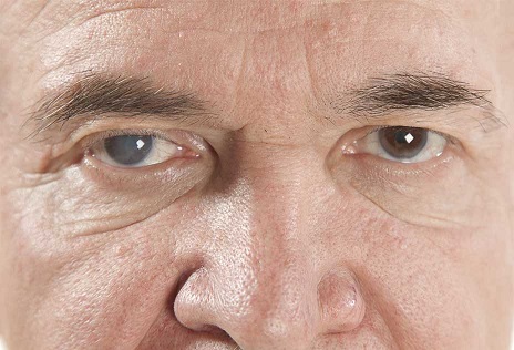 درمان آب‌مروارید و سایر بیماری‌های چشمی؛ بازگرداندن دید سالم