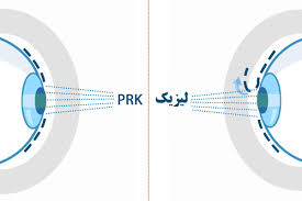 👁️ تفاوت جراحی لیزیک و لازک؛ دو روش نوین برای اصلاح دید