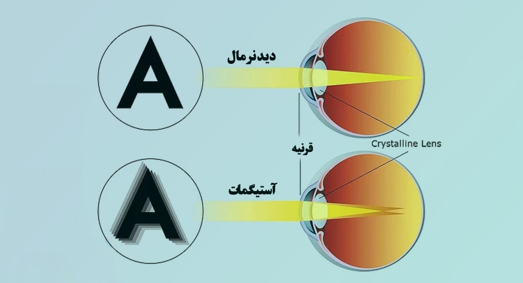 آستیگمات چیست و چگونه درمان میشود؟ راهنمای کامل مخصوص بیماران گیلانی