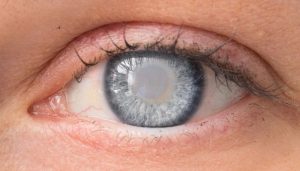 جراحی آب‌مروارید در آستانه اشرفیه | درمان قطعی و ایمن