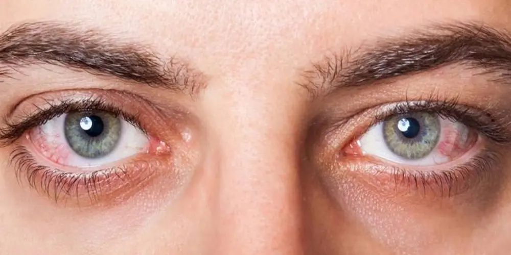 آبمروارید و جراحیها | راهنمای کامل تشخیص، درمان و روشهای جدید