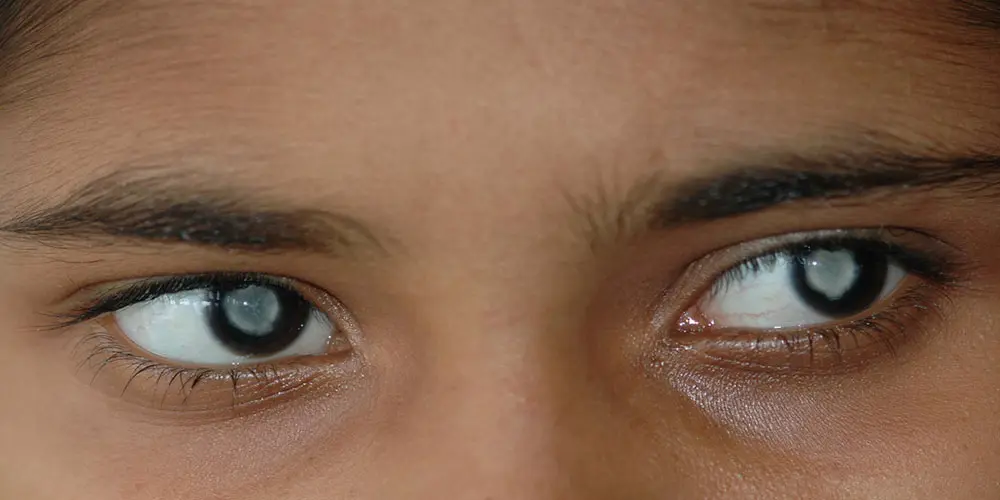 علائم و دلایل آب‌مروارید چشم + بهترین روش درمان در گیلان