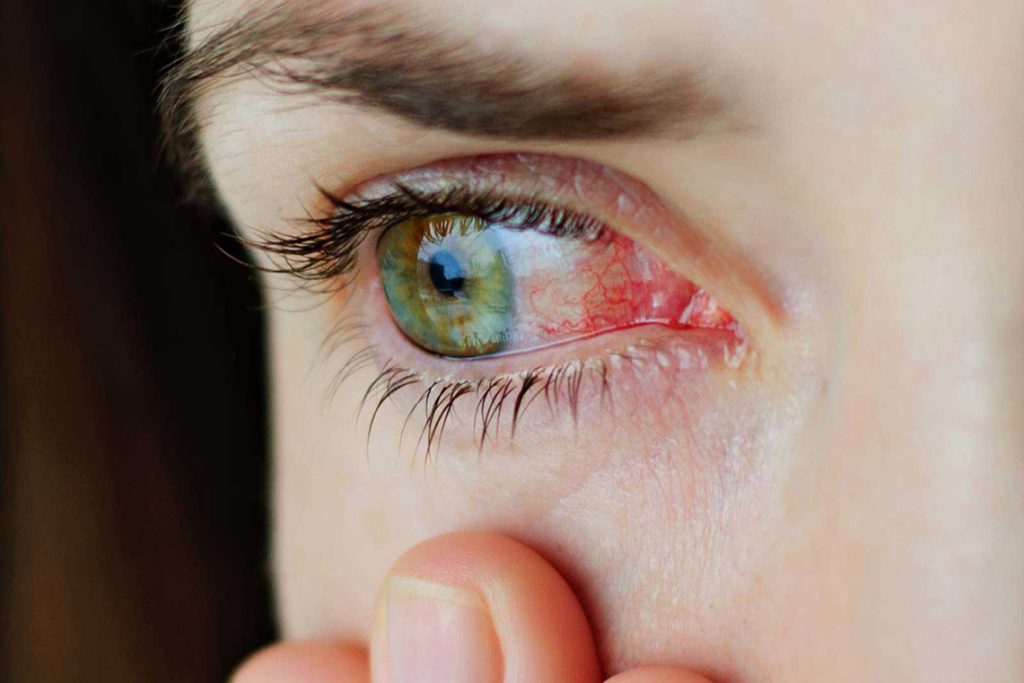 درمان خشکی چشم در آستانه اشرفیه | علت، علائم و راه‌های موثر