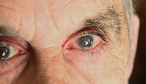 آب‌مروارید و جراحی‌ها | راهنمای کامل تشخیص، درمان و روش‌های جدید