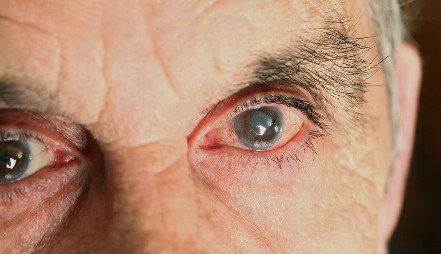 آبمروارید و جراحیها | راهنمای کامل تشخیص، درمان و روشهای جدید