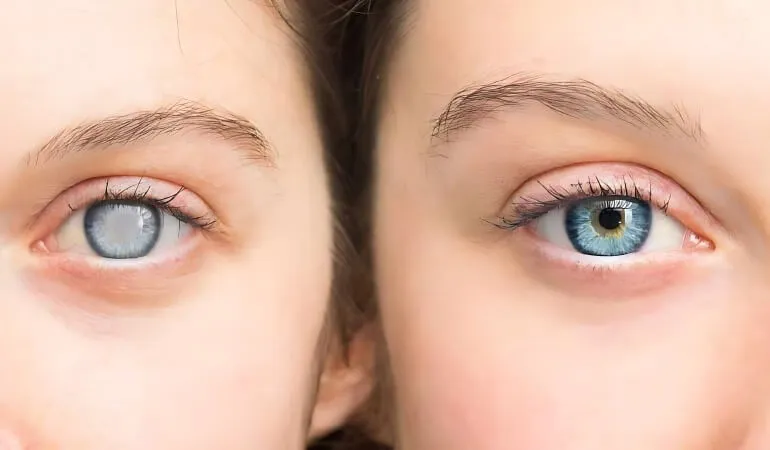 علائم و دلایل آب‌مروارید چشم + بهترین روش درمان در گیلان