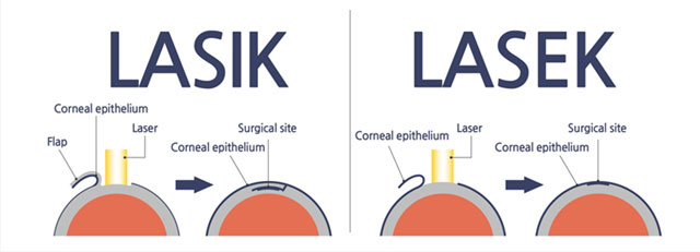 لیزیک و لازک | تفاوتها، مزایا و بهترین روش برای اصلاح بینایی