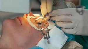 عمل لیزیک چشم در گیلان | اصلاح دید بدون عینک با تکنیک‌های روز