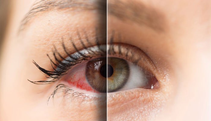 درمان خشکی چشم در آستانه اشرفیه | علت، علائم و راه‌های موثر