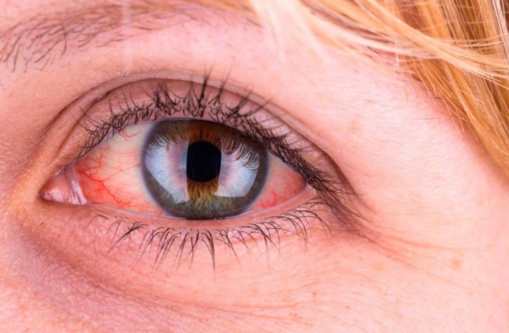 درمان قرمزی مداوم چشم در آستانه اشرفیه | گزینه‌های پزشکی