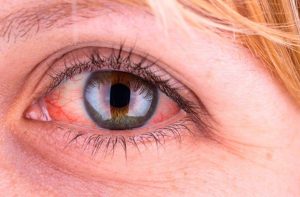 درمان قرمزی مداوم چشم در آستانه اشرفیه | گزینه‌های پزشکی