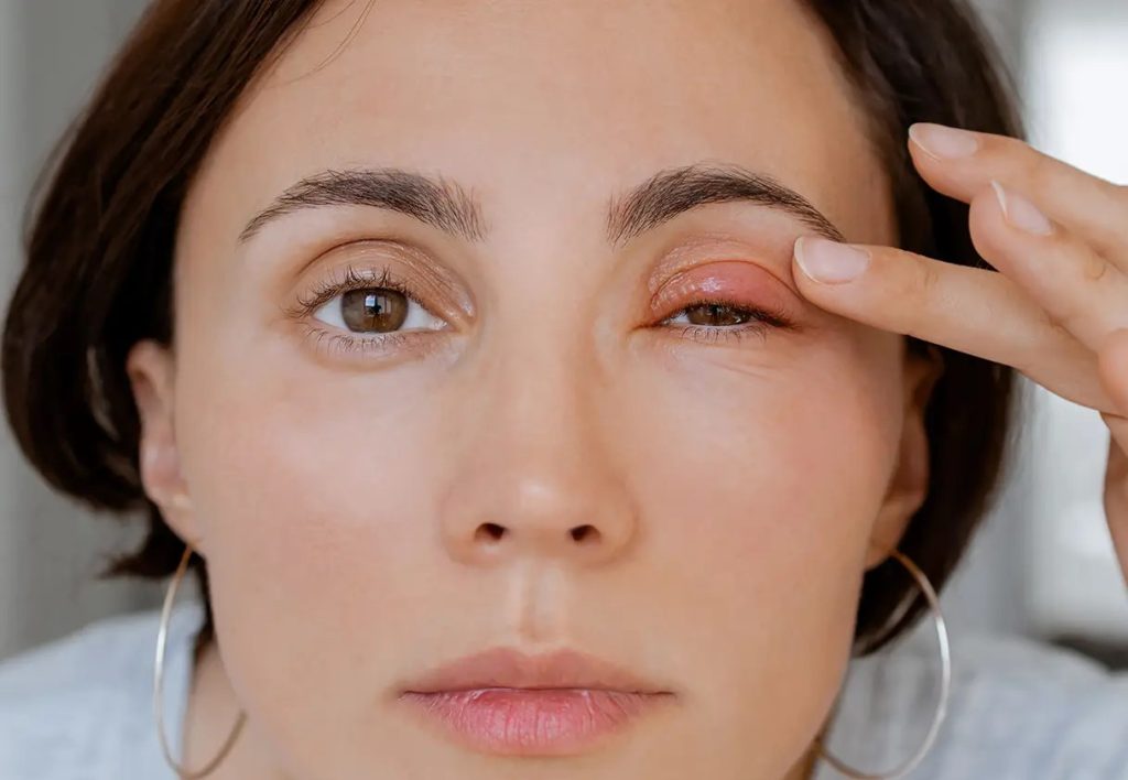 درمان عفونت‌های چشمی در آستانه اشرفیه | روش‌های پزشکی موثر