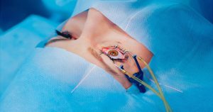 عمل لیزیک و لازک در آستانه اشرفیه | کدام روش مناسب‌تر است؟