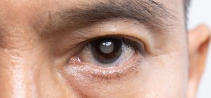 تشخیص و درمان گلوکوم (آب‌سیاه) در آستانه اشرفیه