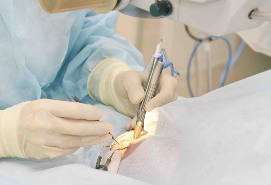 عمل جراحی شبکیه در آستانه اشرفیه | روش‌ها و مراقبت‌های بعد از عمل